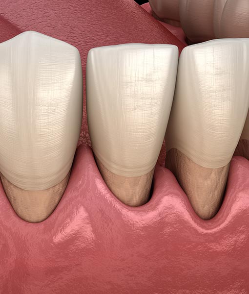 Parodontologie, saignement de la gencive, mobilité des dents, abcès parodontaux